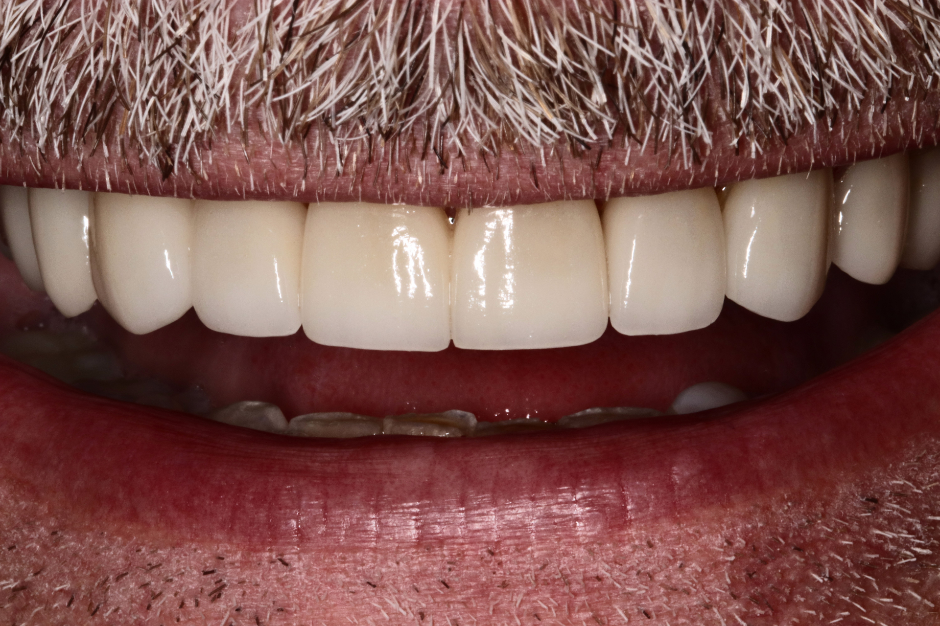 Porcelain Veneers — after