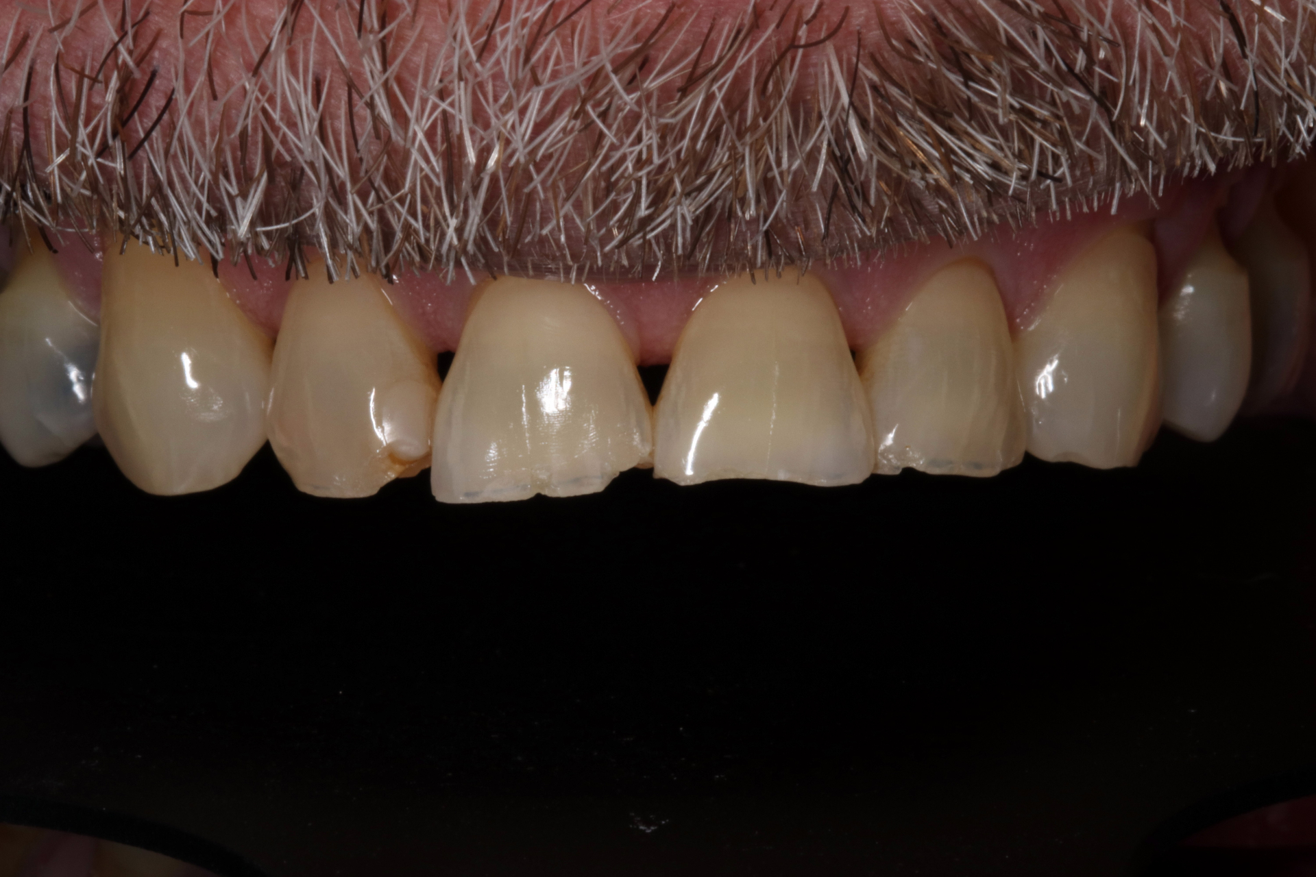Porcelain Veneers — before