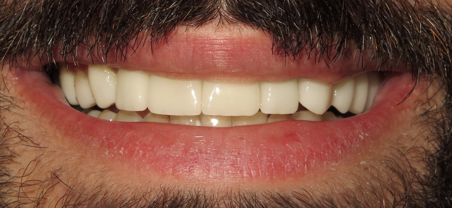 Professional Whitening — after